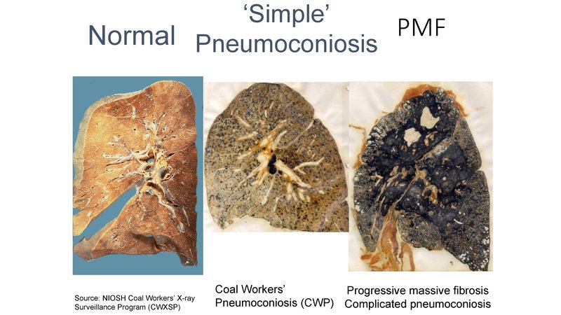 A slide from a presentation by the National Institute for Occupational Safety and Health shows the progression from a healthy lung to advanced black lung disease. CREDIT: NIOSH