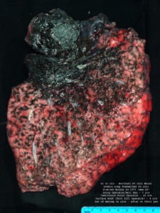 The lung of deceased West Virginia coal miner Chester Fike was taken out during a double lung transplant when he was 60. He worked in the mines for 35 years. CREDIT: NIOSH