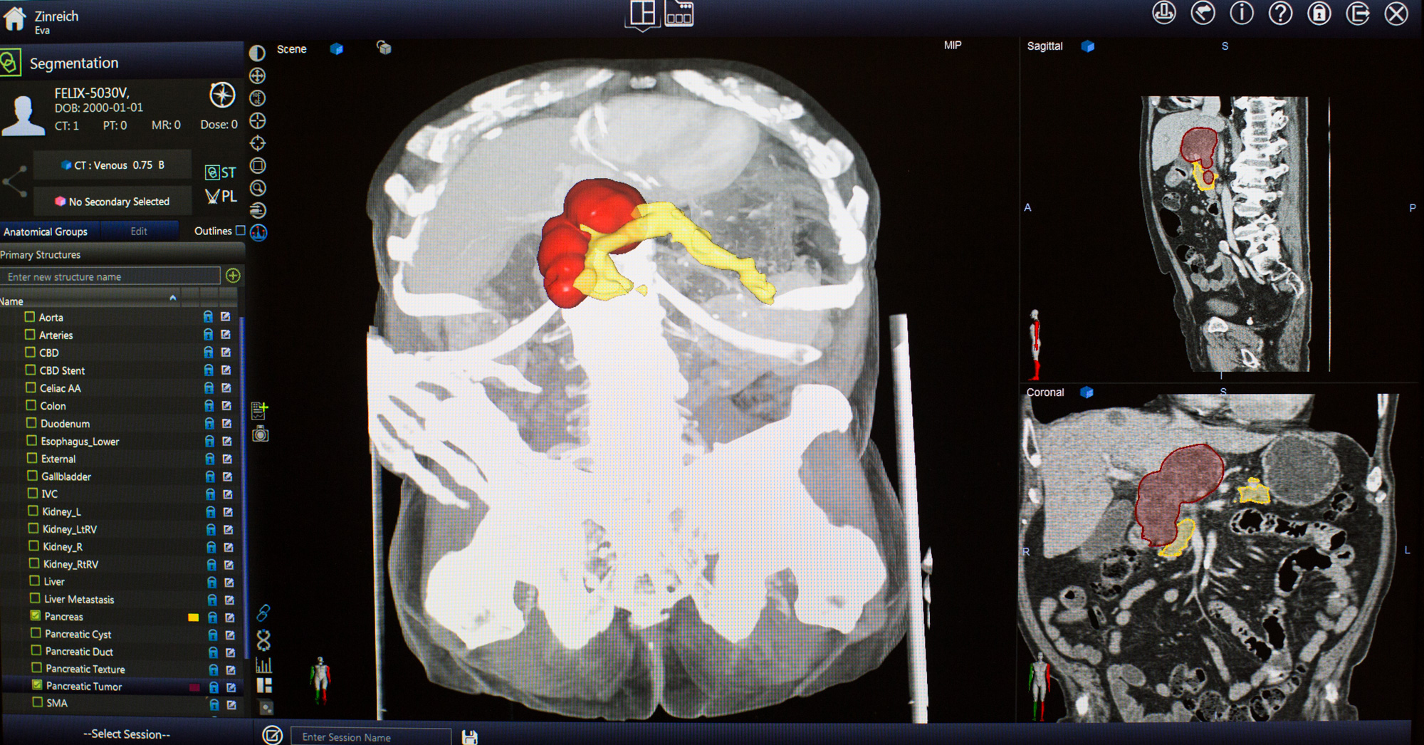 Zinreich digitally paints the pancreas (yellow) and a tumor (red) in a CT scan. CREDIT: Meredith Rizzo/NPR