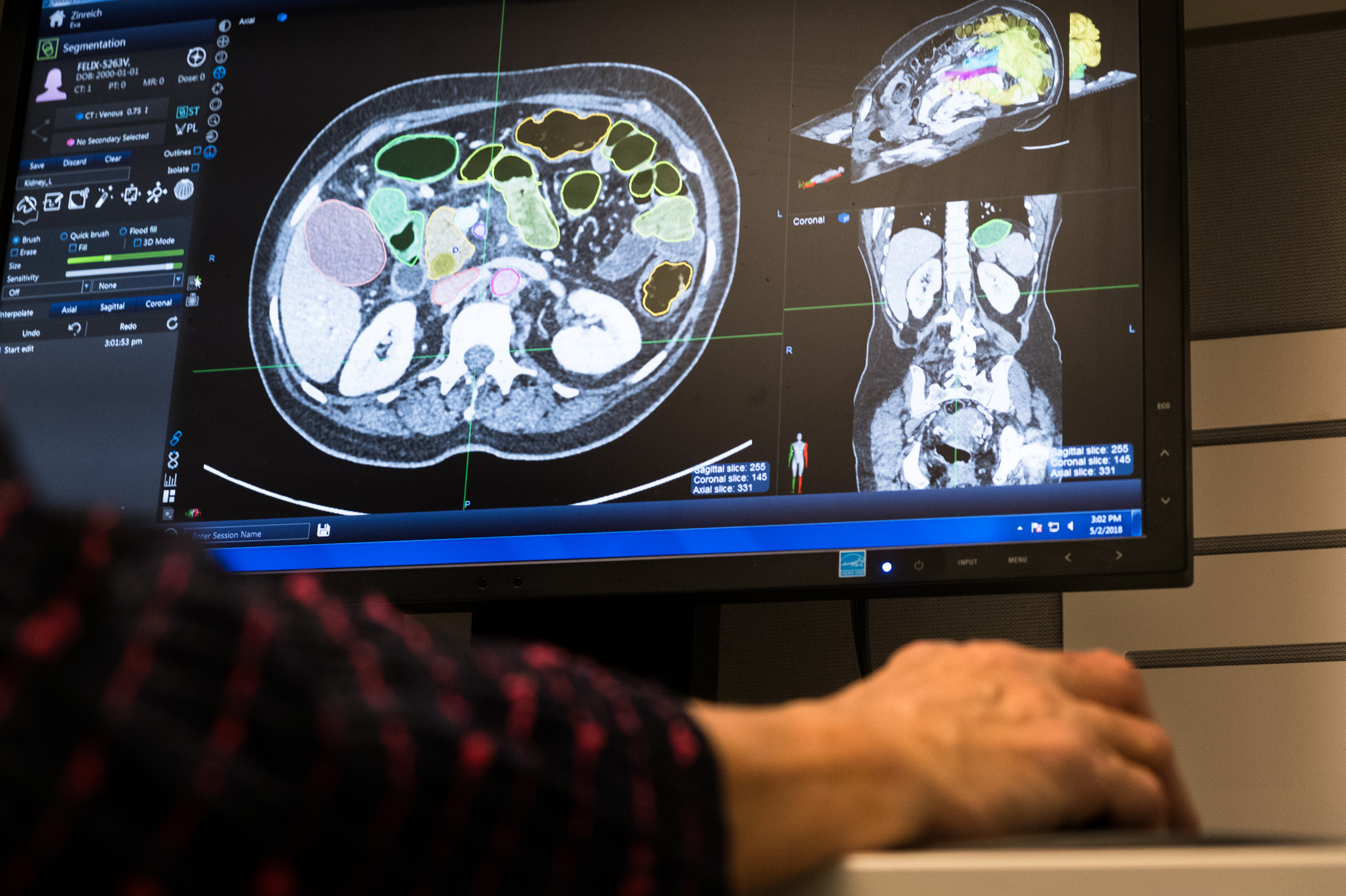 Eva Zinreich, a medical researcher, digitally paints a CT scan to help train the computer program. The process can take almost four hours for a single scan. CREDIT: Meredith Rizzo/NPR