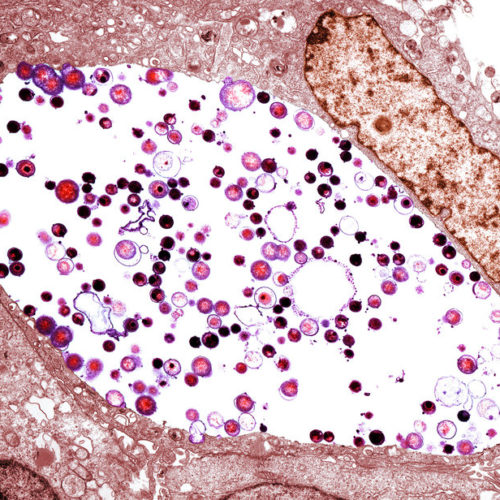 A tinted transmission electron micrograph of Chlamydia trachomatis bacteria (light purple/black) inside a cell. Chlamydia is the most common sexually transmitted disease in the U.S., with more than 1.7 million reported cases in 2017. Biomedical Imaging Unit, Southampton General Hospital/Science Source