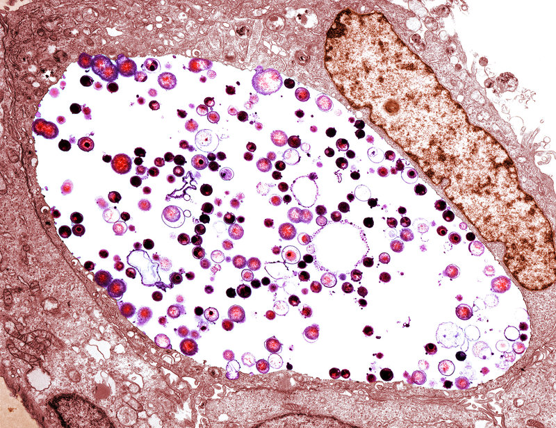 A tinted transmission electron micrograph of Chlamydia trachomatis bacteria (light purple/black) inside a cell. Chlamydia is the most common sexually transmitted disease in the U.S., with more than 1.7 million reported cases in 2017. Biomedical Imaging Unit, Southampton General Hospital/Science Source