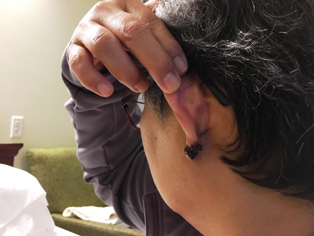 Berni, a nurse at Western State Hospital, shows where a patient bit off her earlobe during an assault in September. CREDIT: AUSTIN JENKINS