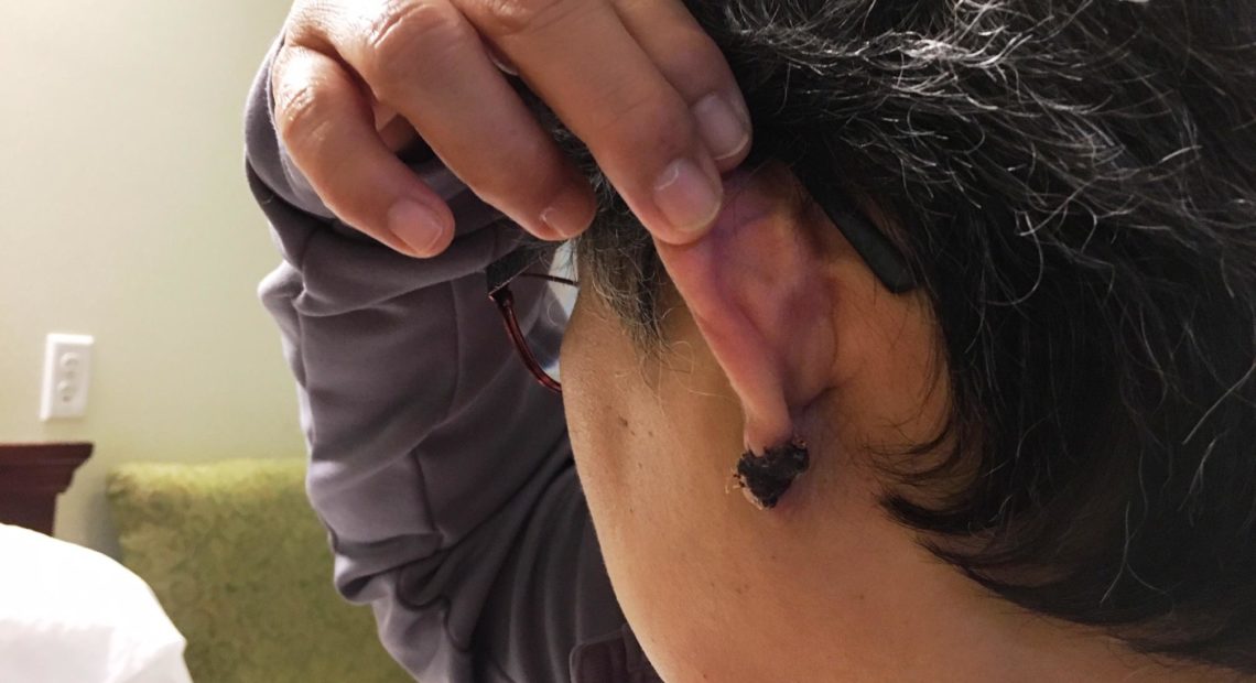 Berni, a nurse at Western State Hospital, shows where a patient bit off her earlobe during an assault in September. CREDIT: AUSTIN JENKINS