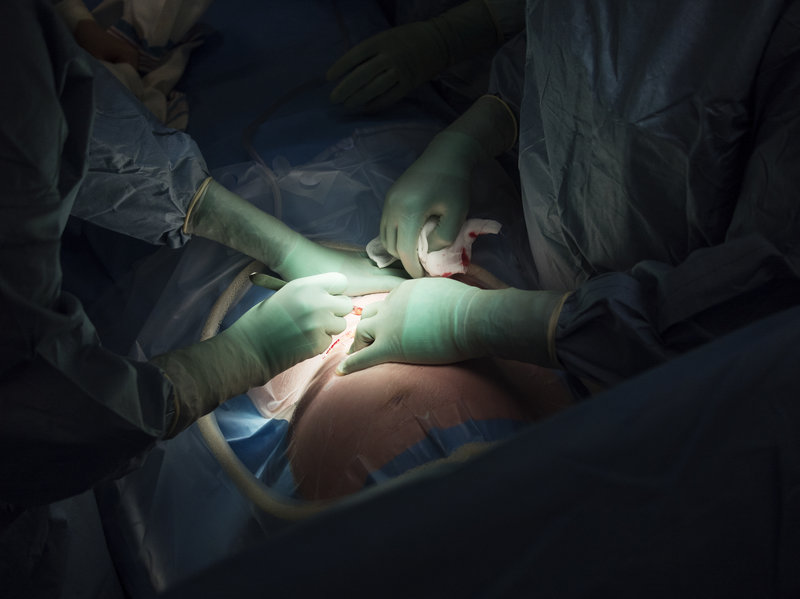 Surgeons perform a cesarean section. A new report raises concerns about rising rates of this procedure around the world, from Brazil to China. Getty Images