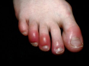 Chilblains (pictured) are itchy, red, pink or purple inflammations of the skin's small blood vessels that can develop in body parts such as toes and fingers from exposure to colder temperatures or wet conditions. A similar-looking inflammation of the toes is an emerging symptom of COVID-19 and is being referred to as "COVID toes."