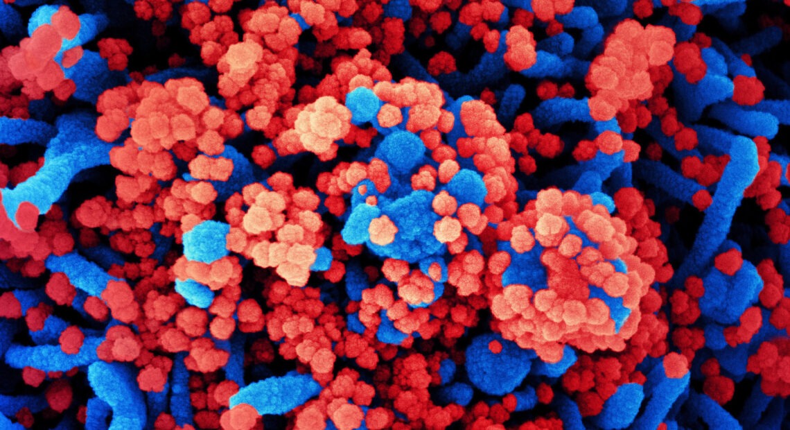 SARS-CoV-2 virus particles, shown in red, have heavily infected a cell in this colorized scanning electron micrograph. SARS-CoV-2 is the virus that causes COVID-19. NIAID/NIH/Flickr