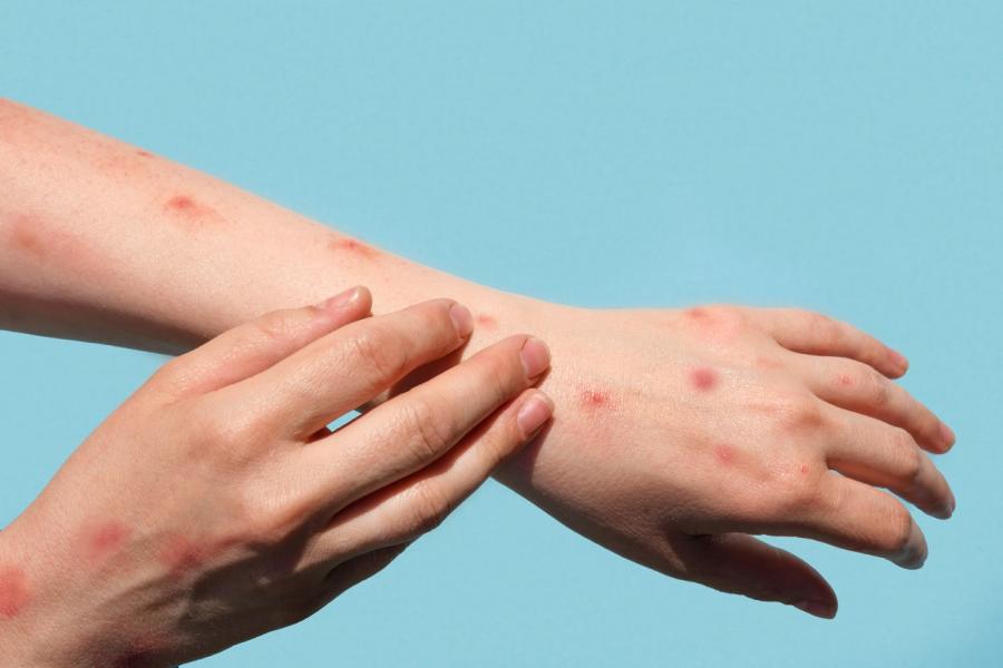 Photo of monkeypox symptoms on an arm